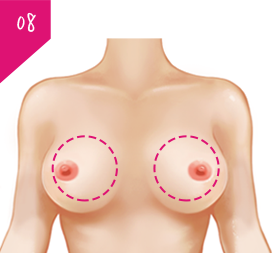假体再手術及乳房重建时补充