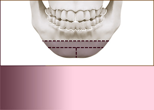 骨の顎先延長術