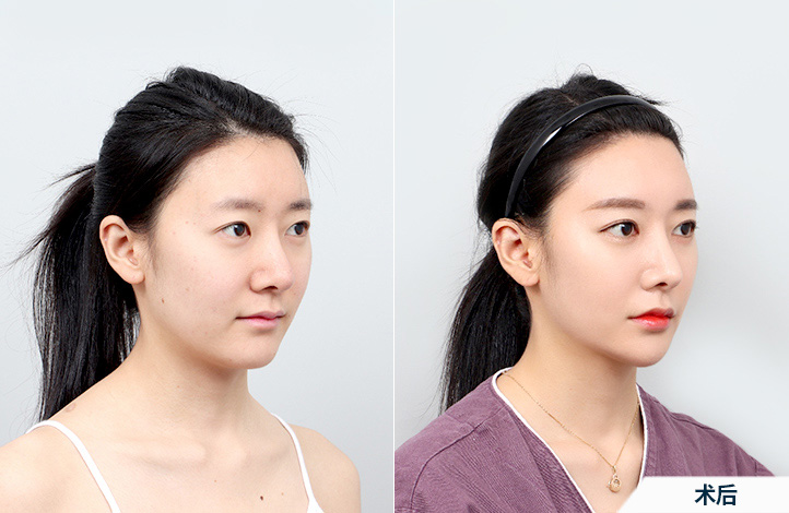 before_after_45º