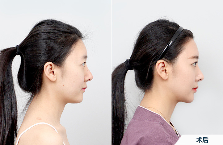before_after_side