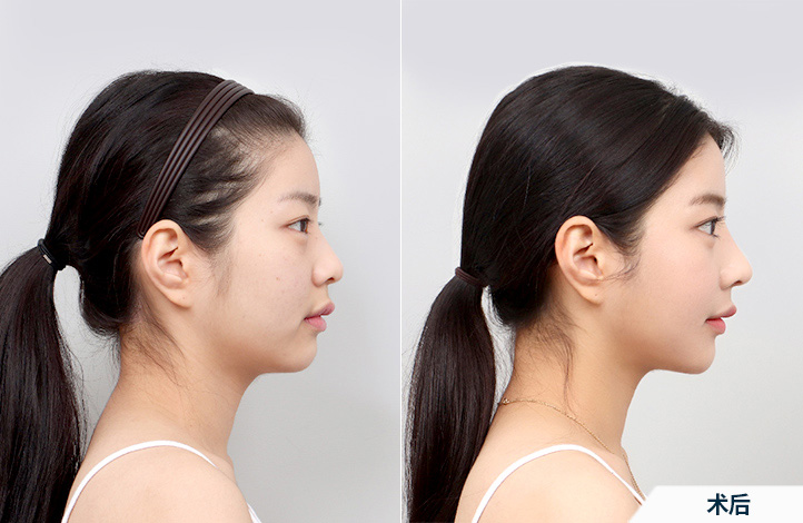 before_after_side