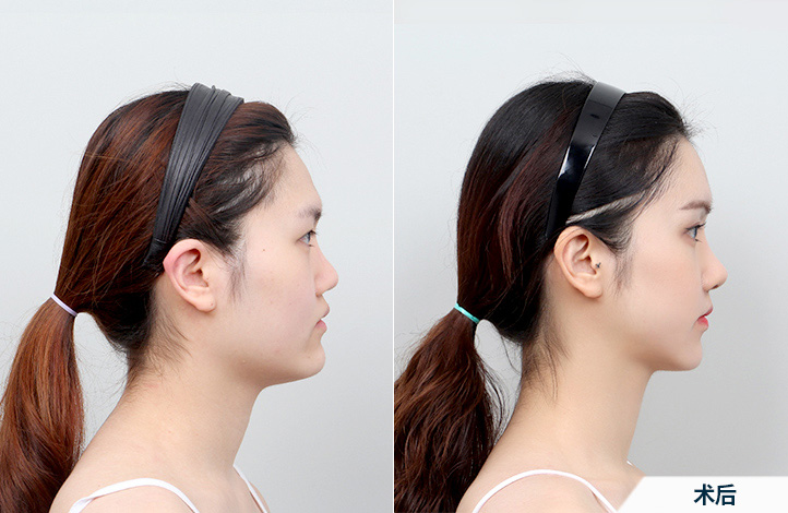 before_after_side