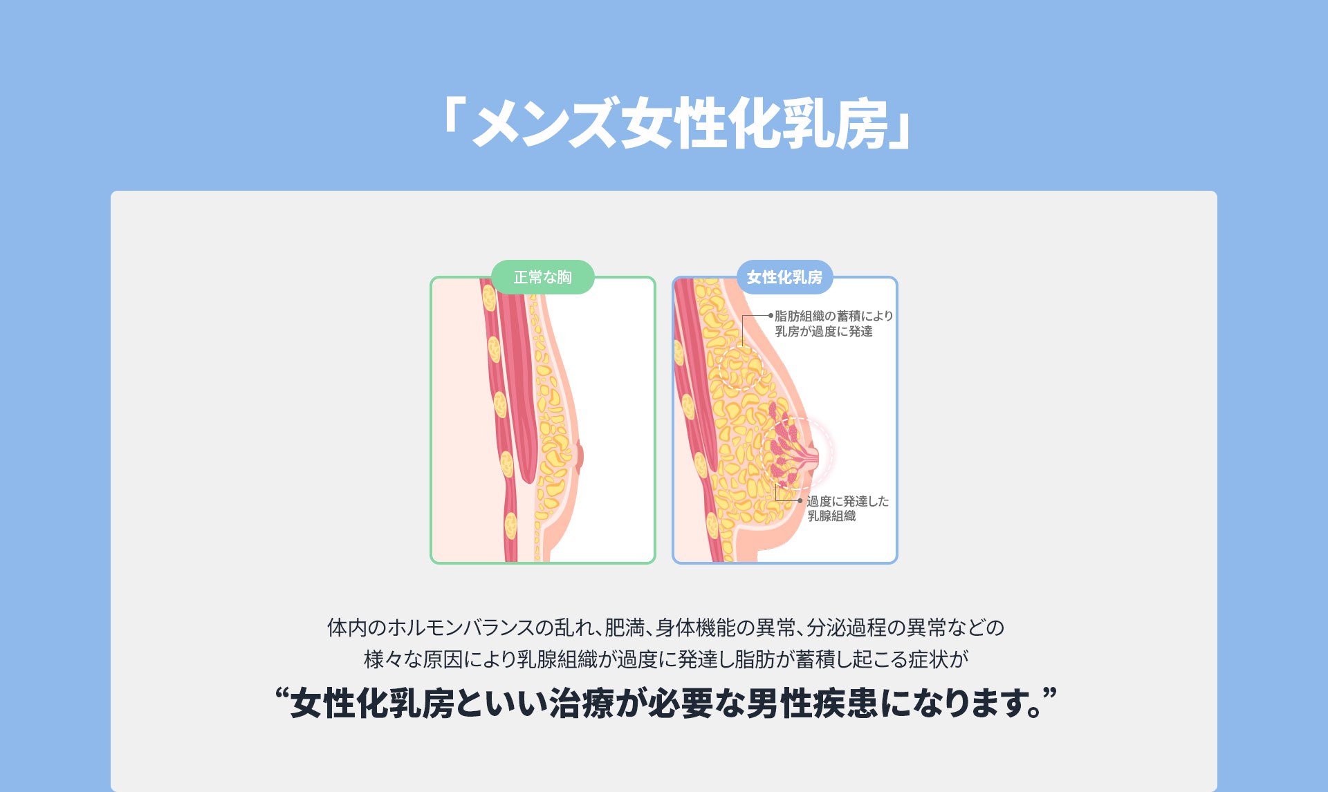 DA 女性化乳房