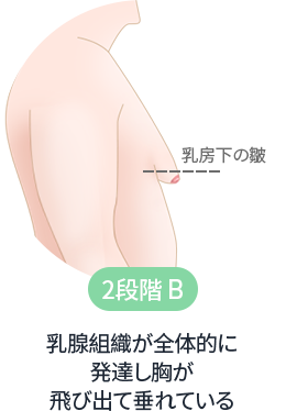 乳腺組織が全体的に発達し胸が飛び出て垂れている