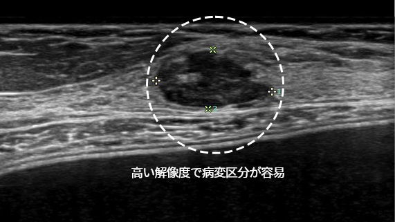 高い解像度で病変区分が容易 