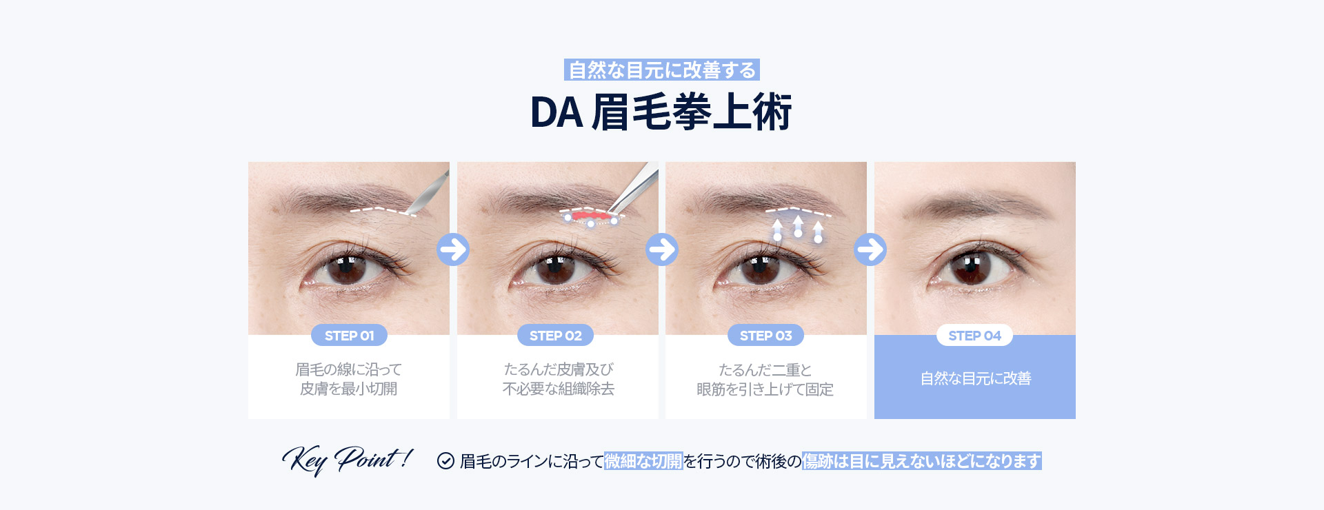 DA眉毛拳上術