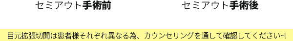 セミアウト手術前&手術後