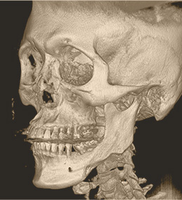 顔面輪郭CTBEFORE 手術後