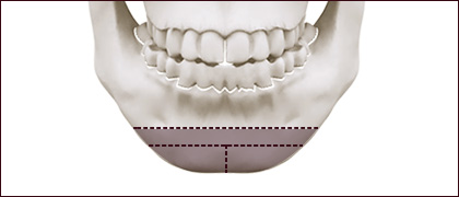 骨の顎先延長術