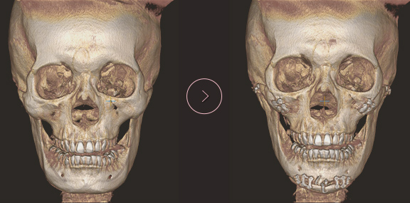 顎先長さ延長・縮小術 ct BEFORE & AFTER 