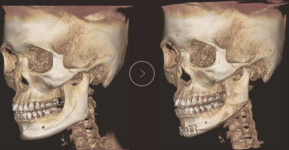 顎先長さ延長・縮小術 ct BEFORE & AFTER 