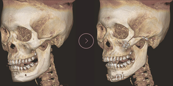 顎先長さ延長・縮小術 ct BEFORE & AFTER 