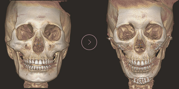 顎先長さ延長・縮小術 ct BEFORE & AFTER 