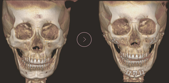 顎先長さ延長・縮小術 ct BEFORE & AFTER 