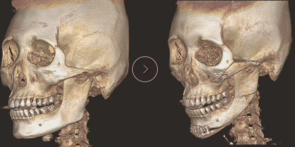 顎先長さ延長・縮小術 ct BEFORE & AFTER 