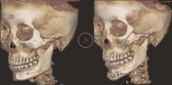 顎先長さ延長・縮小術 ct BEFORE & AFTER 