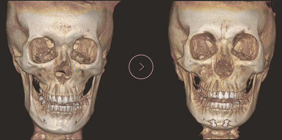 顎先長さ延長・縮小術 ct BEFORE & AFTER 