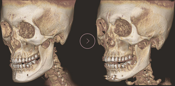 顎先長さ延長・縮小術 ct BEFORE & AFTER 