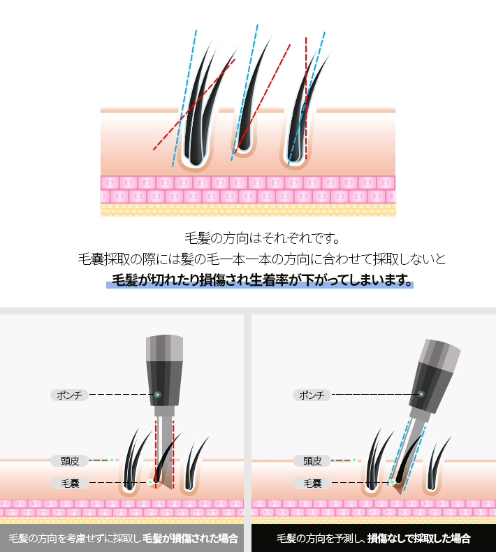 生着率は損傷のない毛嚢の採取から始まります。