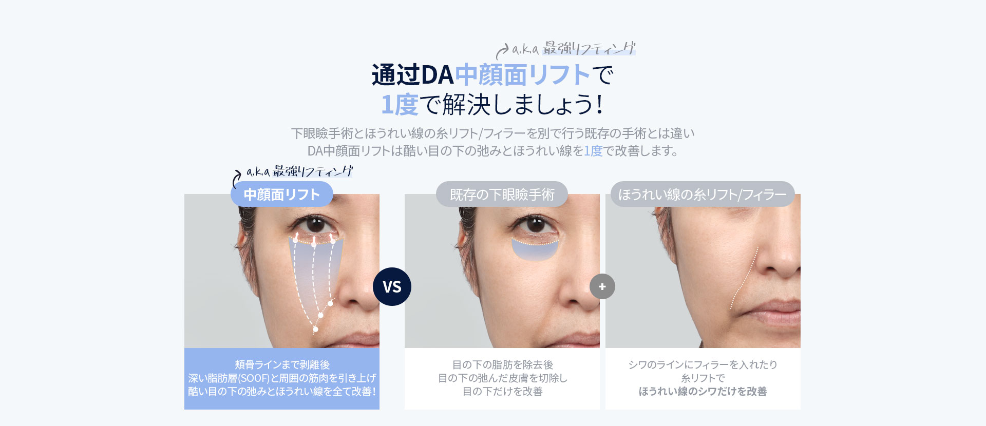 DA中顔面リフト