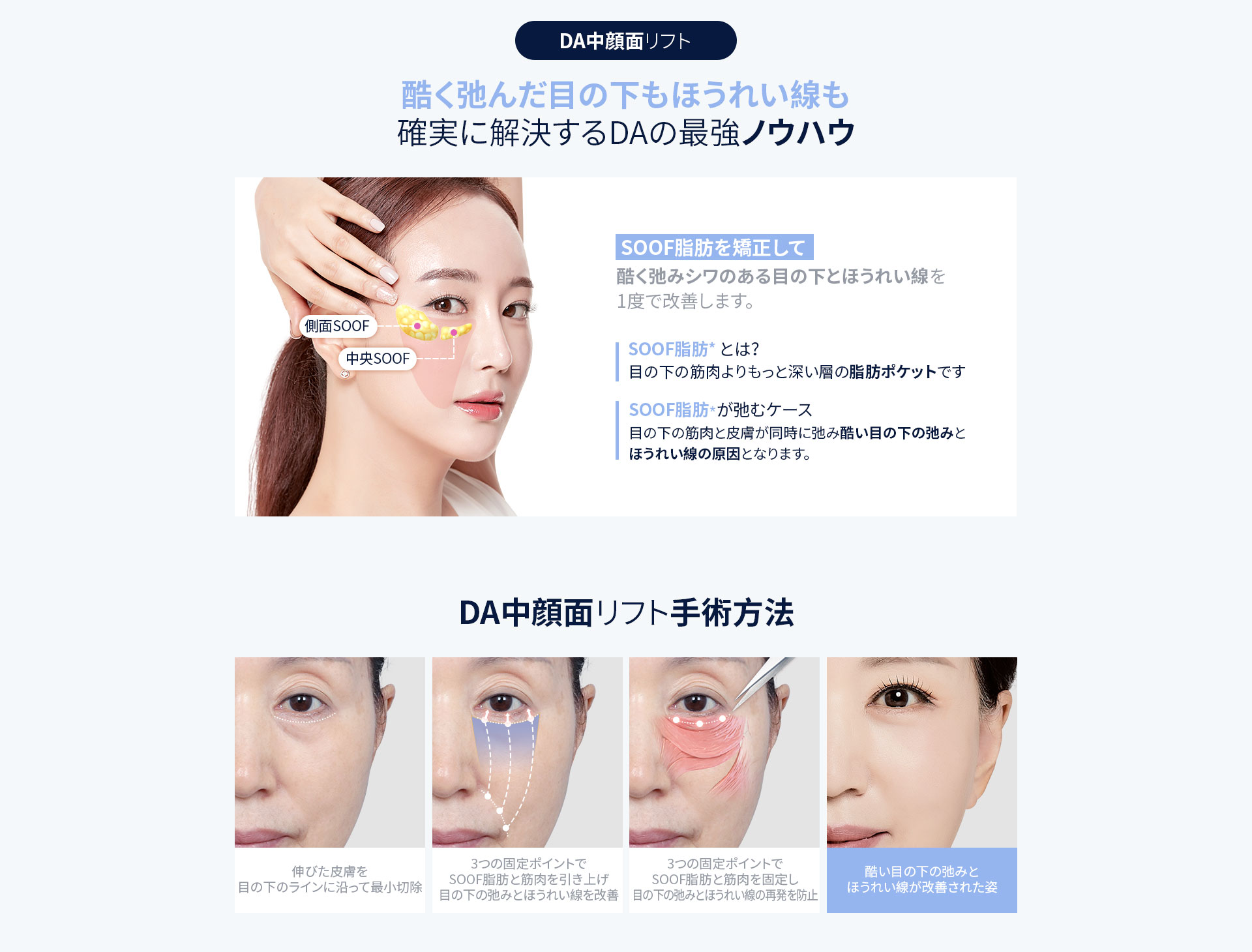 DA中顔面リフト