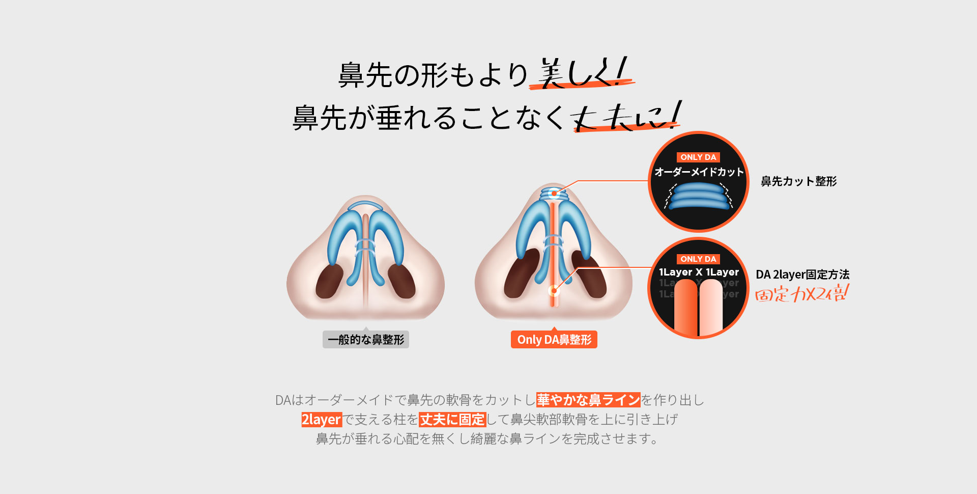 自家肋軟骨鼻整形