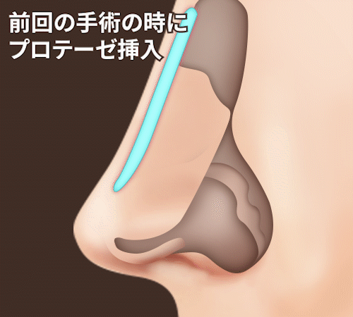 鼻再手術ソリューション 