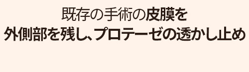 鼻再手術ソリューション 