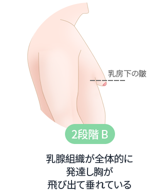 DA 女性化乳房