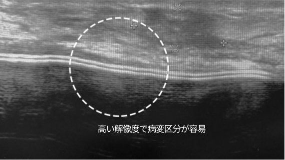 高い解像度で病変区分が容易 