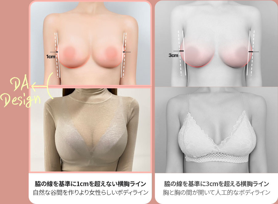 DA豊胸整形