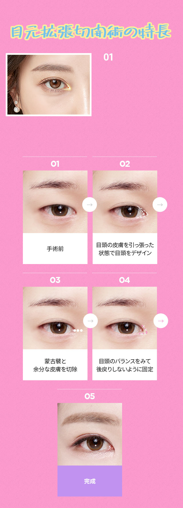 DA目元拡張切開術
