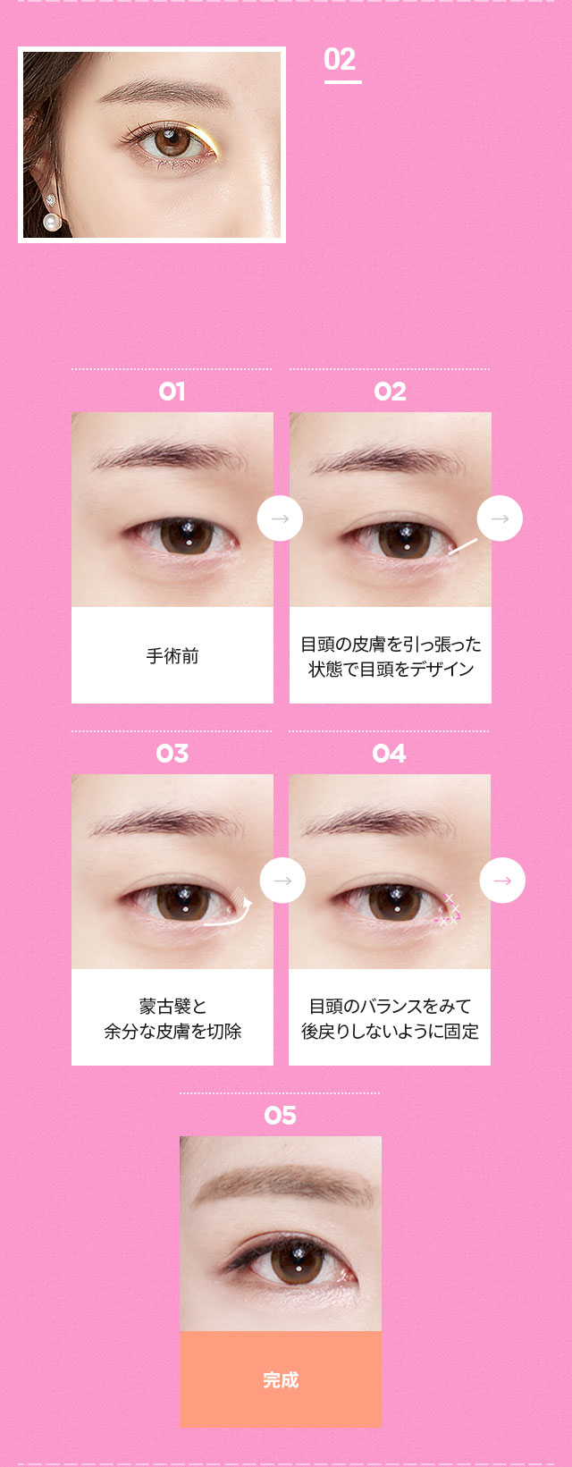 DA目元拡張切開術