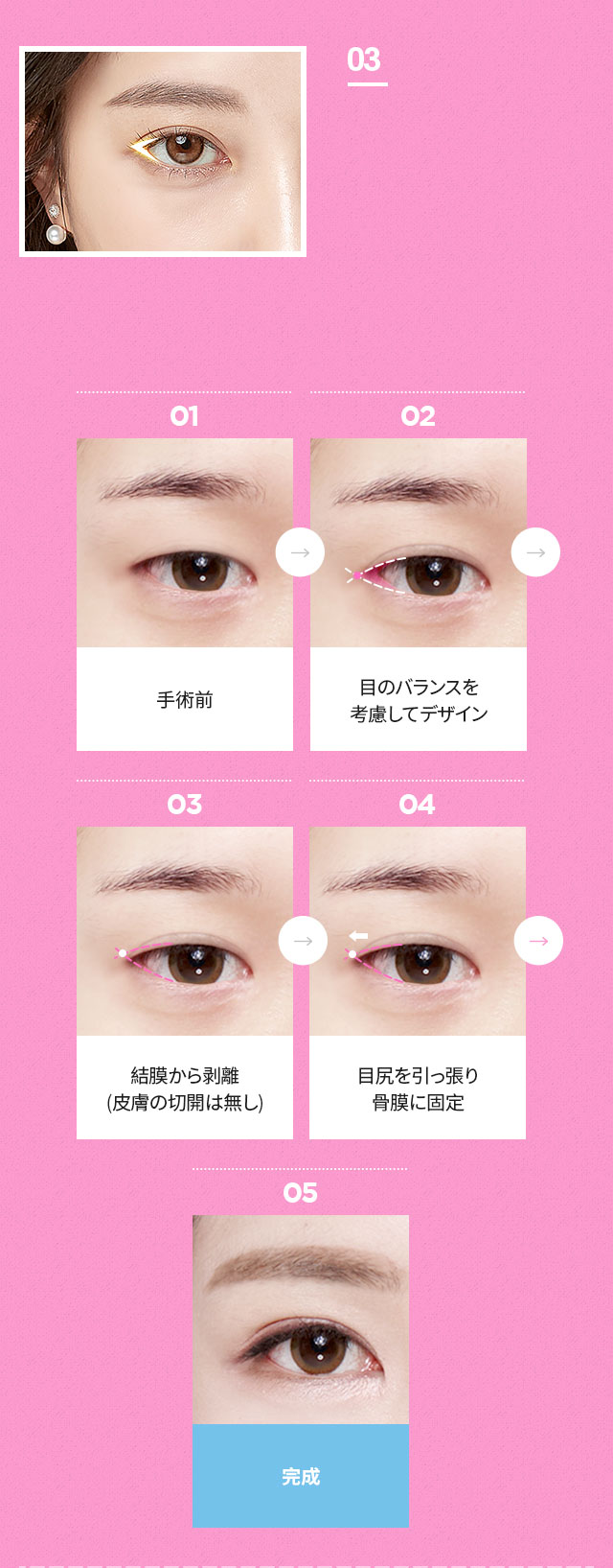 DA目元拡張切開術