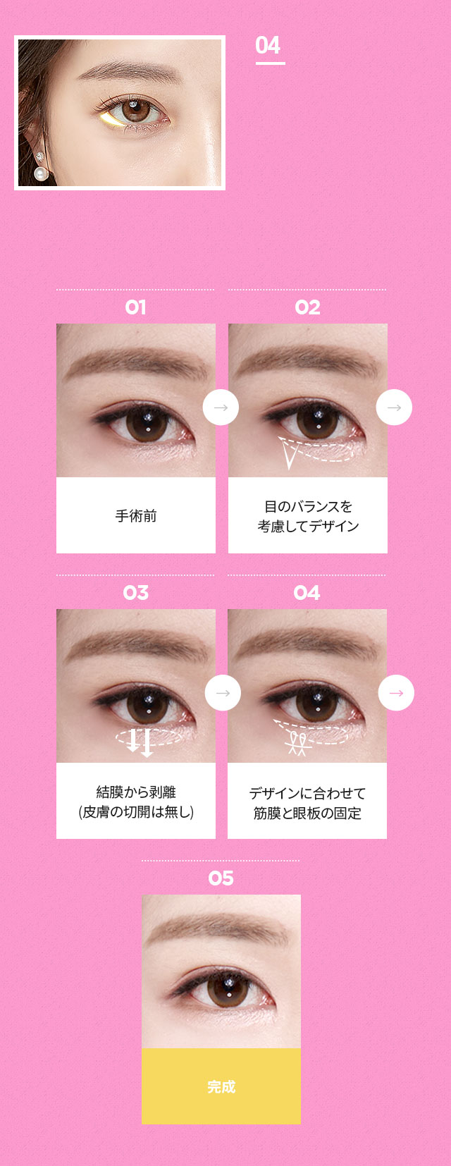 DA目元拡張切開術
