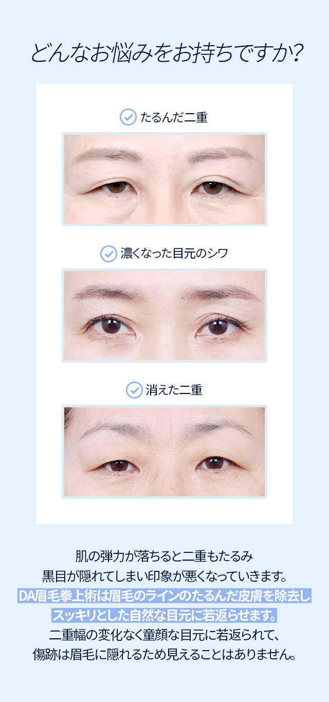 DA眉毛拳上術は眉毛のラインのたるんだ皮膚を除去しスッキリとした自然な目元に若返らせます。