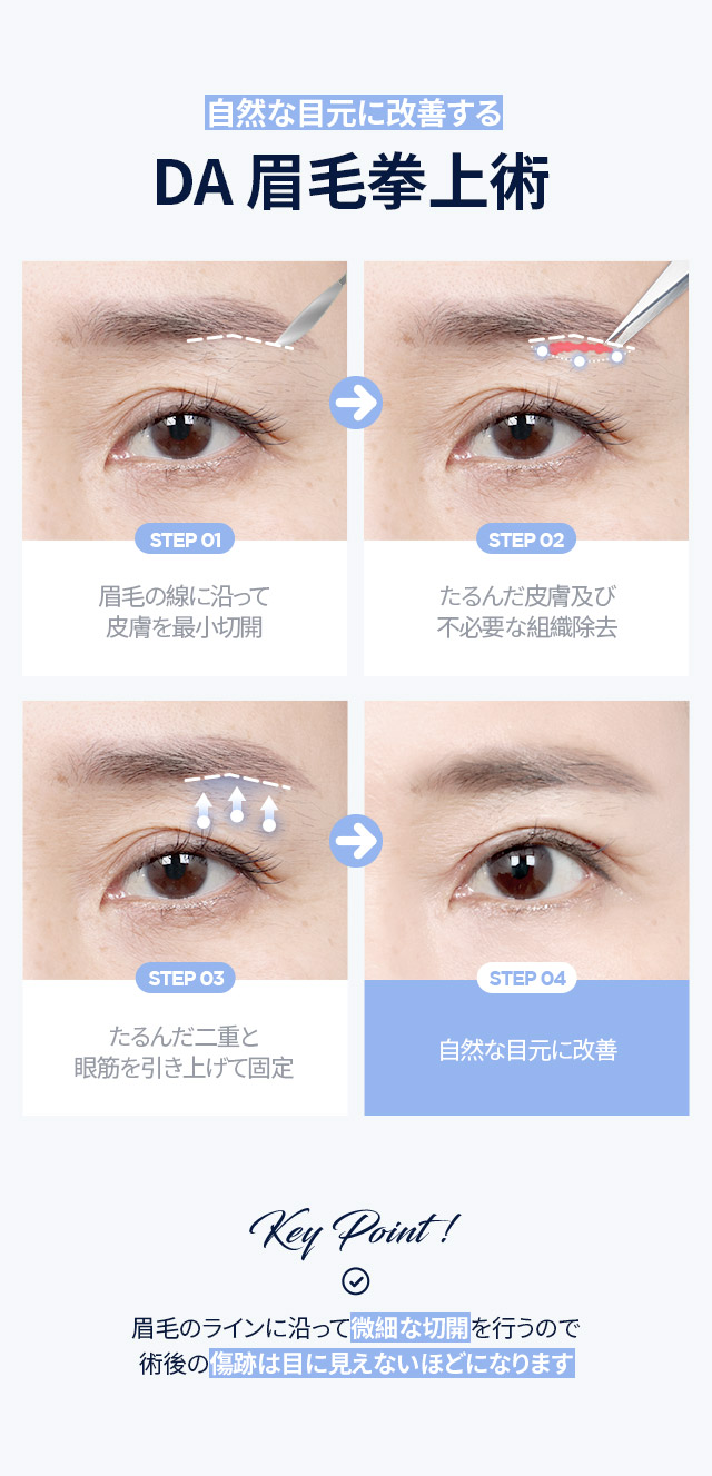 DA眉毛拳上術