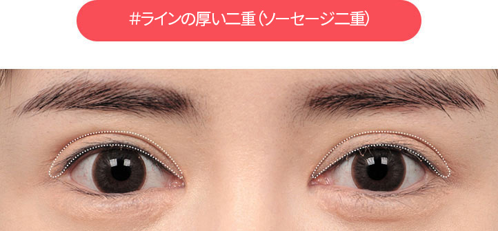 DA #ライン付き太い二重まぶた(ソーセージ二重まぶた)