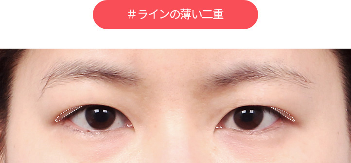 DA#細い線の二重まぶた 