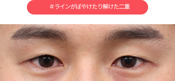 DA#ぼやけたまたは緩んだ線を持つ二重まぶた 