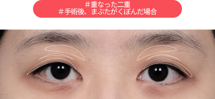DA#二重まぶた # 手術後にまぶたが切れた場合 