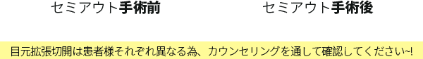 セミアウト手術前&手術後