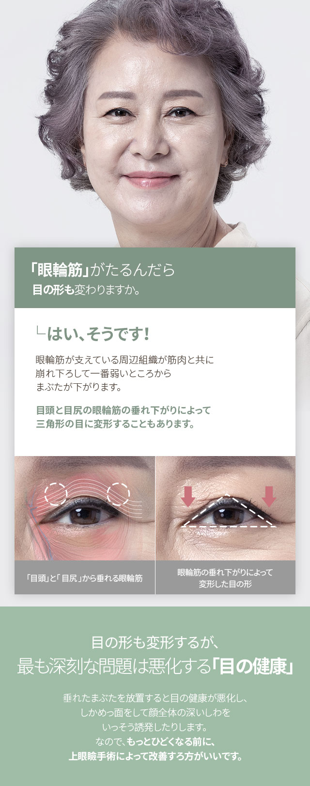 大ヒット上眼瞼