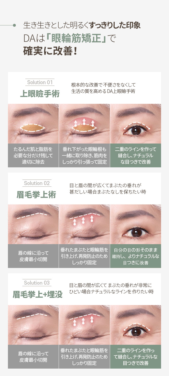 大ヒット上眼瞼