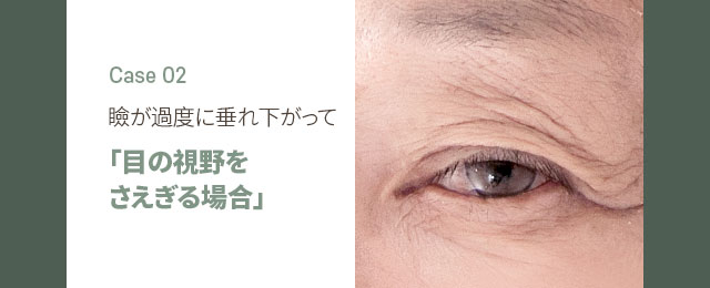 瞼が過度に垂れ下がって[「目の視野をさえぎる場合」]