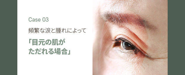 [頻繁な涙と腫れによって] 「目元の肌がただれる場合」