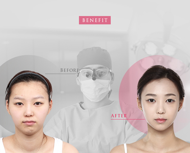 Before After 下巴形状变化