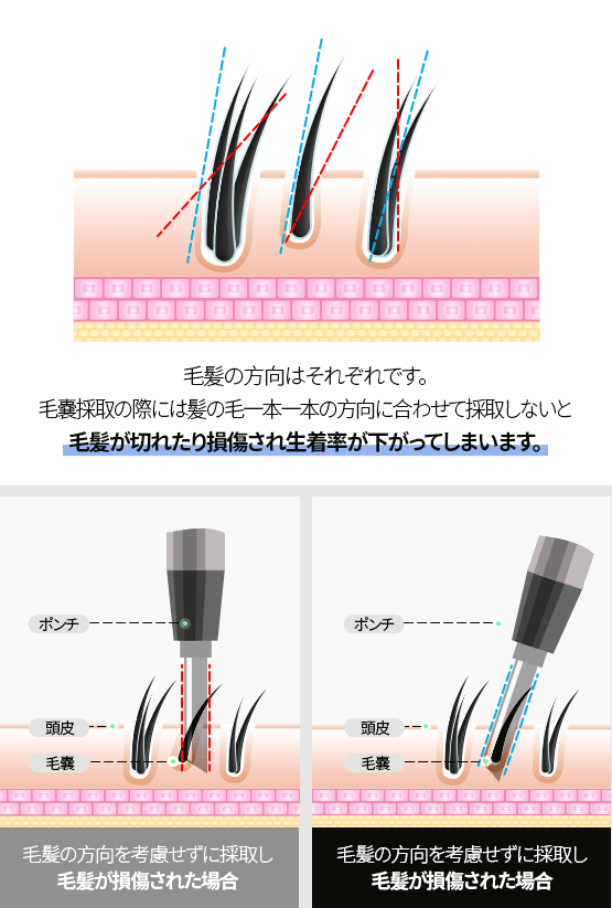 生着率は損傷のない毛嚢の採取から始まります。