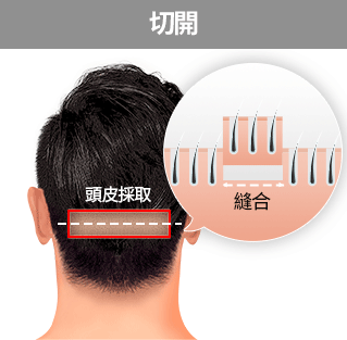 切開