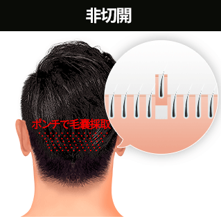 非切開